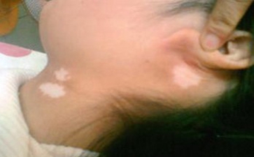 白癜风在治疗时应注意什么问题 儿童的颈部长出了白癜风怎么办