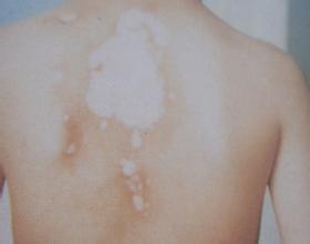 早期白癜风能治愈吗 白癜风的治疗方法有哪些