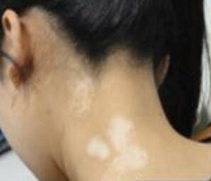 如何科学诊断白癜风 皮肤上的白斑是不是白癜风呢