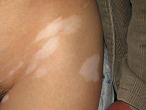 白癜风怎么治疗好一点 白殿风应该要怎么治疗