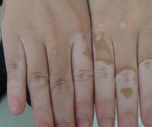 患了白癜风应怎样进行治疗 皮肤上长了白斑会不会是白癜风