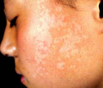 到底白癜风早期能治愈吗 白癜风可以不用检查吗