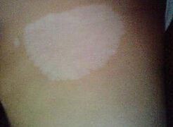 得了白癜风怎么办? 青少年白癜风怎么才能治好