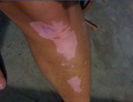 治疗白癜风疾病时患者要注意什么 白癜风会出现在脚部该如何治呢