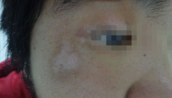 白癜风需要多长时间 早期白癜风该怎么去治疗呢