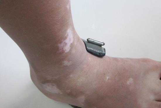 得了白癜风白斑应该怎么治 得了白癜风应该如何治疗才好