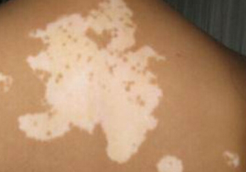 武汉308激光治白癜风费用 武汉308激光治白癜风