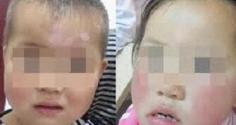 小孩手上长白癜风怎么治疗呢 白癜风的原因症状和治疗方法介绍