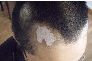 治疗脸部白癜风偏方