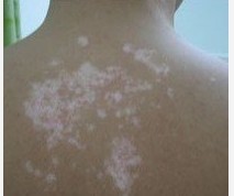 白癜风偏方治疗办法有哪些 关于白癜风的治疗方法有哪些