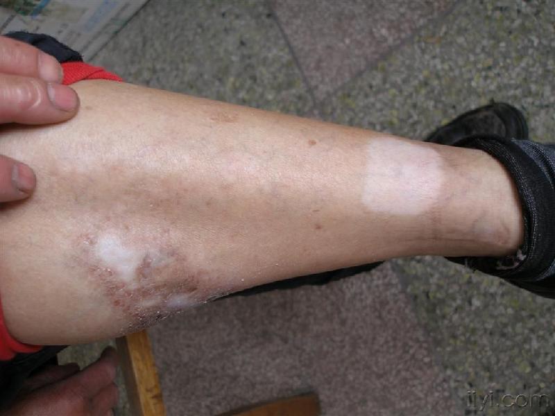 关于白癜风的治疗方法 白癜风在哪治效果好