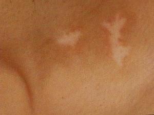 手部白癜风如何治疗呢 快速治疗白癜风的偏方有哪些