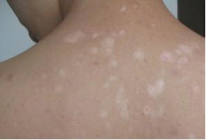 白斑病的治疗原则有哪些 怎样早日治愈白癜风疾病