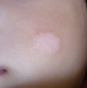 白癜风疾病为什么难以治愈 白癜风该怎么控制病情