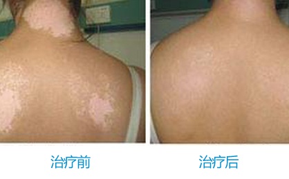 白癜风病因有哪些呢 引发白癜风病因有哪些