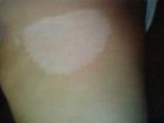 小孩白癜风症状有哪些 年轻人白癜风临床症状