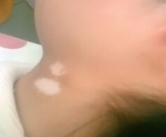 秋季白癜风预防措施有哪些 白癜风患者的预防有哪些