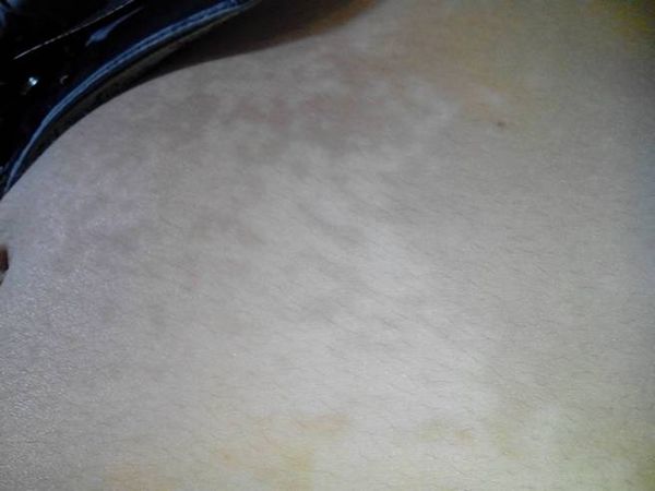 年轻人白癜风治疗如何护理比较好? 青年人治疗白癜风怎么保护皮肤