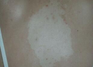 白癜风药物治疗可取吗 到底白癜风早期能治愈吗