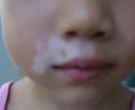 预防白癜风有哪些办法 女性白癜风该怎么预防