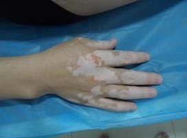 青年人白癜风护理方法有哪些 教你如何护理白癜风