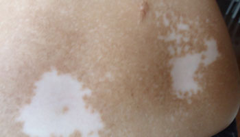 通常治疗白癜风的方法有哪些呢