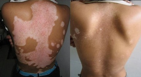 白癜风治疗晚了有什么危害吗 有的白癜风患者为何久治不愈呢