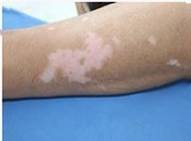 白癜风疾病有治好的可能性吗 白癜风治疗的较好办法