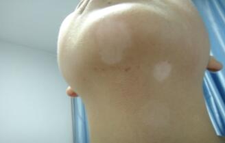 怎样治疗白癜风才比较有保障呢 适合女性白白患者的疗法