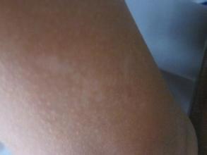 治疗白癜风,哪里能信赖 白癜风治疗你用对办法了吗