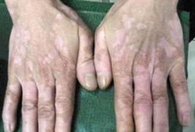 武汉治白癜风的正规医院