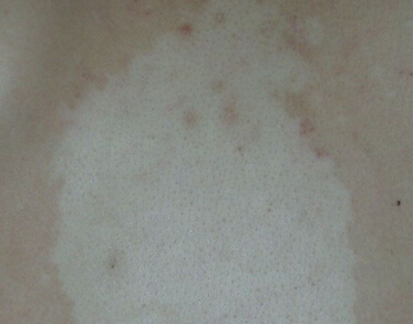 手部白癜风如何预防 扩散性白癜风的预防方法有哪些