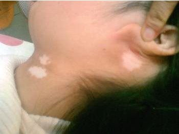 小儿白癜风的治疗方法 儿童白癜风能不能治好