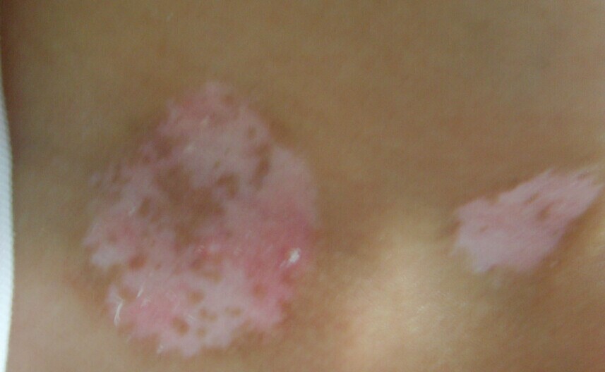 小儿白癜风治疗方法有哪些 吃黑芝麻能治白癜风