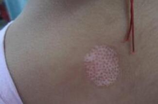 白癜风很难治吗?可以治好吗? 治疗白癜风的常见误区