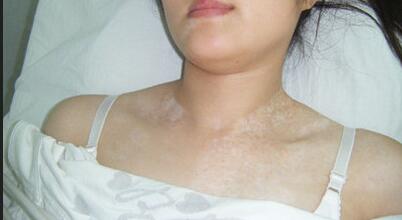 武汉治疗白斑哪个好问环亚 武汉治白斑环亚特约