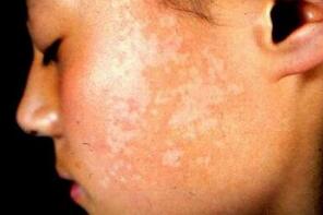 武汉治疗白癜风环亚真挚 武汉白癜风环亚精湛