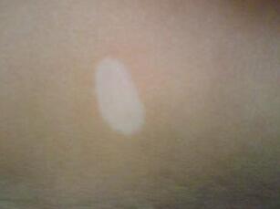 黄石白癜风医院环亚用心 咸宁白斑病医院环亚用心