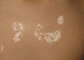 白癜风初期图片环亚真挚 黄冈白癜风医院环亚美誉