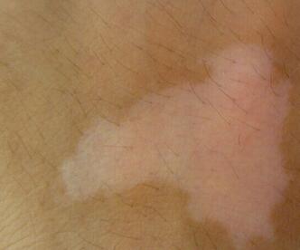 武汉治疗白癜风见效快的是哪种方法 武汉在生活中应该怎么样控制白癜风的发病