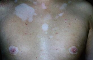 武汉白癜风早期怎么治能好 武汉了解白癜风从而更好的治疗白癜风