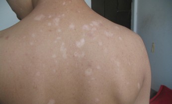 武汉白癜风的治疗注意什么 武汉常见的白癜风的治疗方法都有什么呢