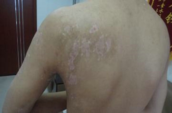 武汉哪些中药能治疗白癜风 武汉患有白癜风能治好吗