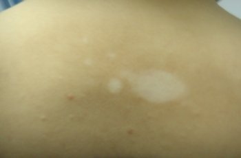 武汉介绍一下治疗白癜风的方法 武汉白癜风的早期治疗要遵循原则