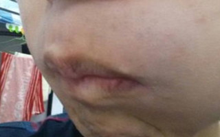 武汉脸部白癜风好治疗吗 武汉白癜风医院介绍早期白癜风怎样治疗