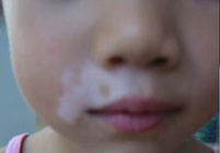 武汉白斑医院详解白癜风的常见症状都是什么 武汉白癜风医院介绍白癜风有哪些临床症状