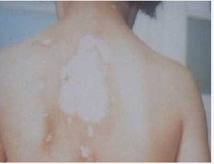 武汉白癜风医院讲解白癜风中医治疗方法 武汉白癜风医院解答土方法治疗白癜风