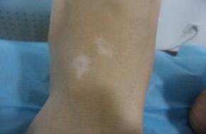 武汉白癜风又快又有效的疗法怎么选择 武汉白癜风最佳治疗期是什么时候