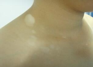 武汉白癜风医院教你早期白癜风治疗如何进行? 武汉白癜风医院教你长了白斑怎么治