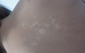 武汉治疗白癜风如何用药 武汉白斑医院讲解青少年白癜风的治疗方法